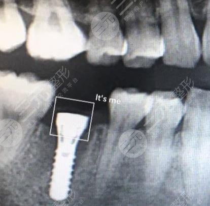 Dental implant case sharing of Shanghai Ruitai Dental Hospital