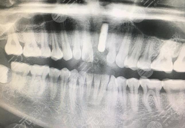 Dental implant case sharing of Changzhou Meiao Dental Hospital