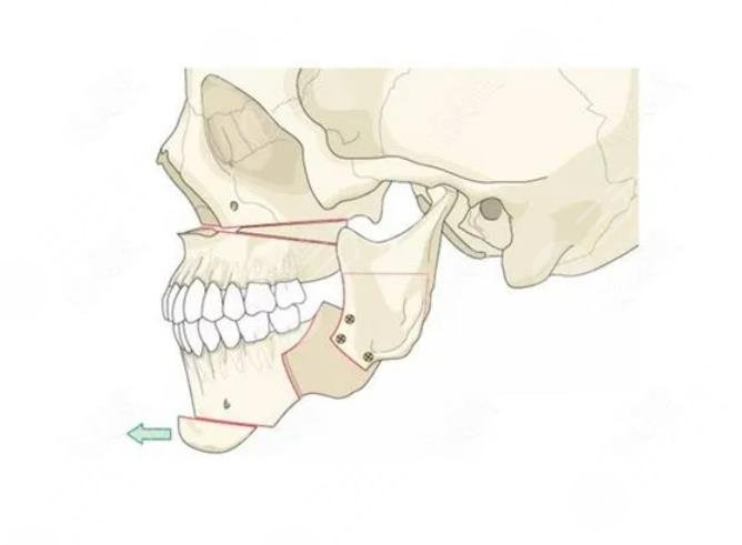 Orthodontic expenses of Chengdu Second People's Hospital
