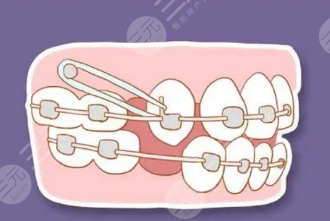 Orthodontic process diagram