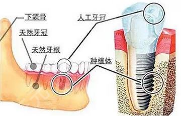 Principles of Dental Implants