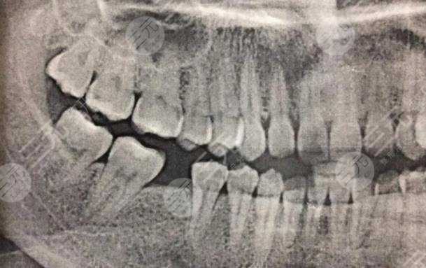 Sharing of dental implant process in Zhongshan Dental Clinic of Jiujiang City