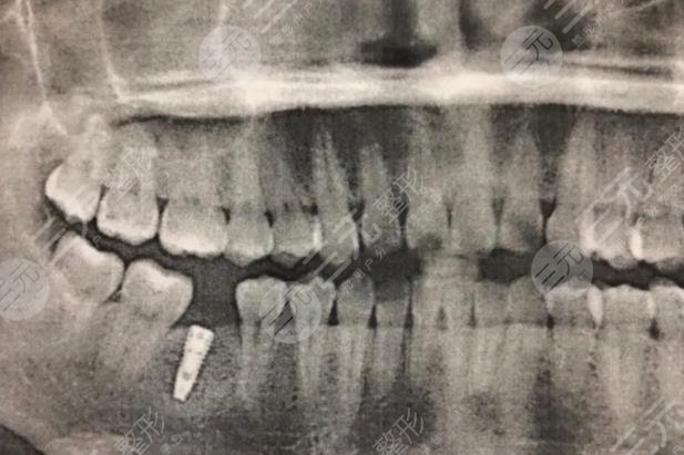 Sharing of dental implant process in Zhongshan Dental Clinic of Jiujiang City