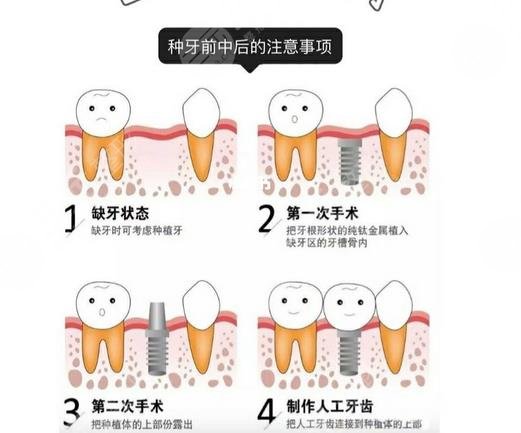 Zhongshan Stomatological Hospital netizens dental implant experience sharing|case