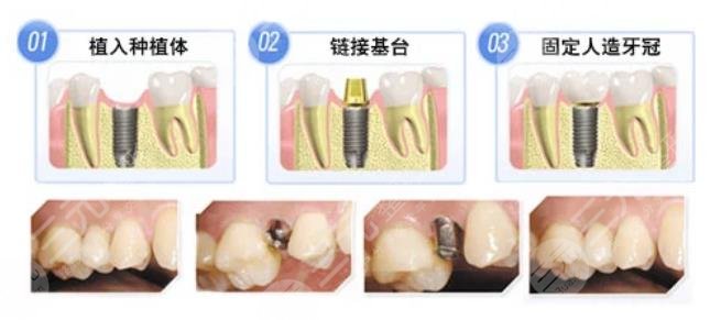 Dental implant technology