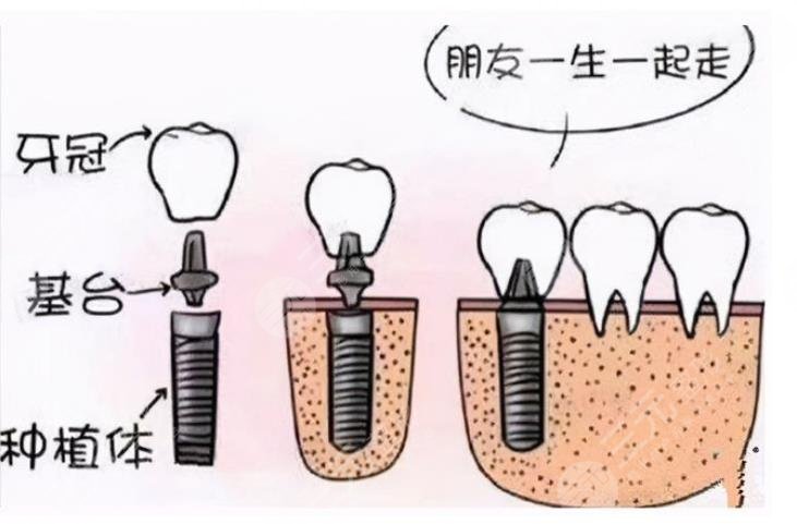 What are the characteristics of dental implants?