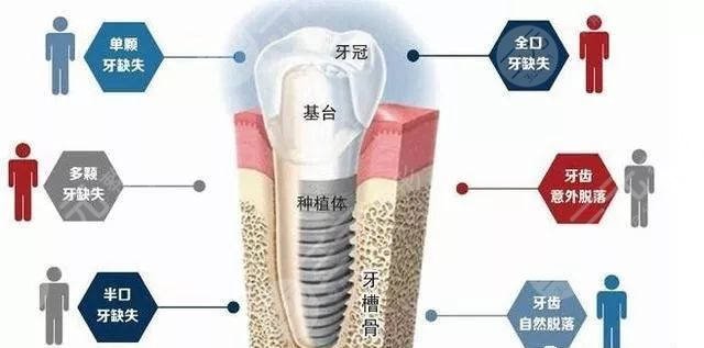 What is the principle of dental implants?