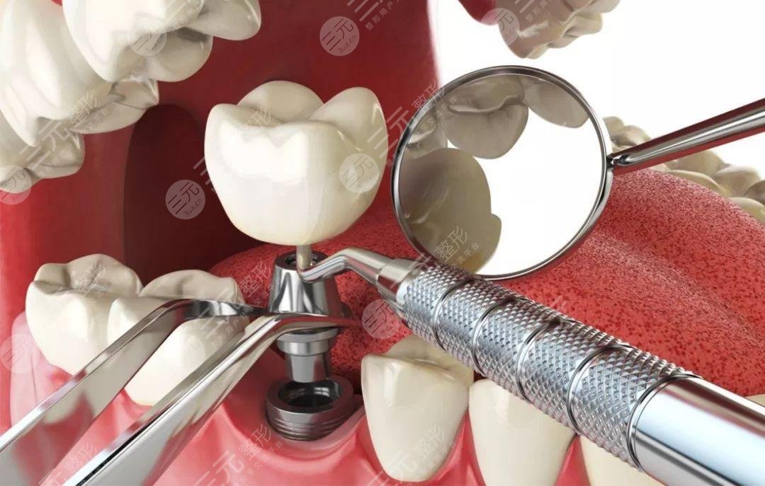 What are the advantages of dental implant technology