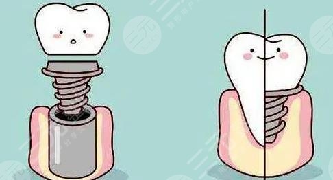 A selection of dental implant cases