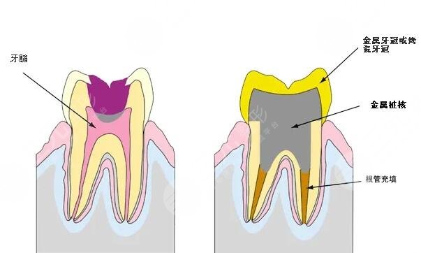 Crown restoration