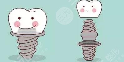 Dental implants