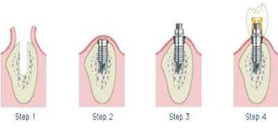 Case sharing of dental implants in Beijing Air Force General Hospital