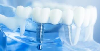 Dental implants