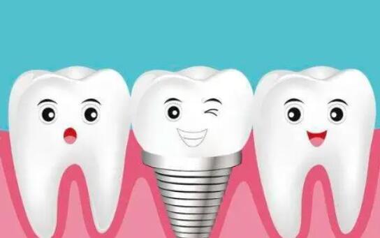 Dental implants