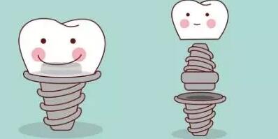 Dental implants