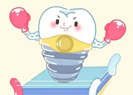 Dental implants