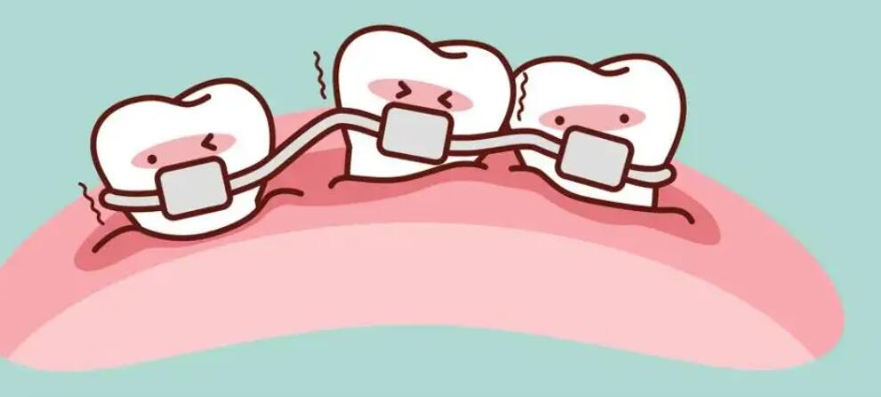 Dental implants