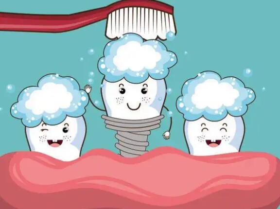 Dental implants