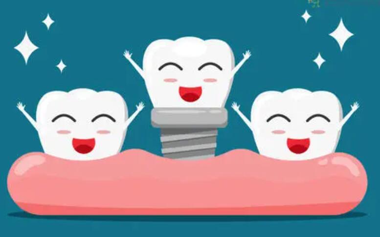Dental implants