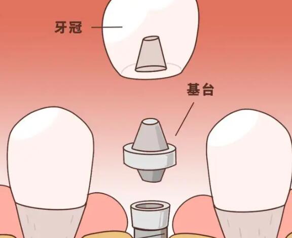 Dental implants